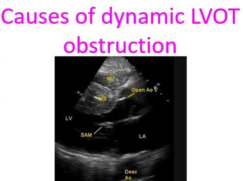 what is dynamic lvot obstruction.